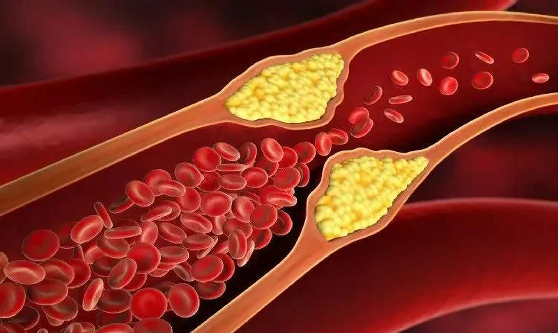 斑块是在血管内膜下形成并嵌入血管组织,难以清除干净.