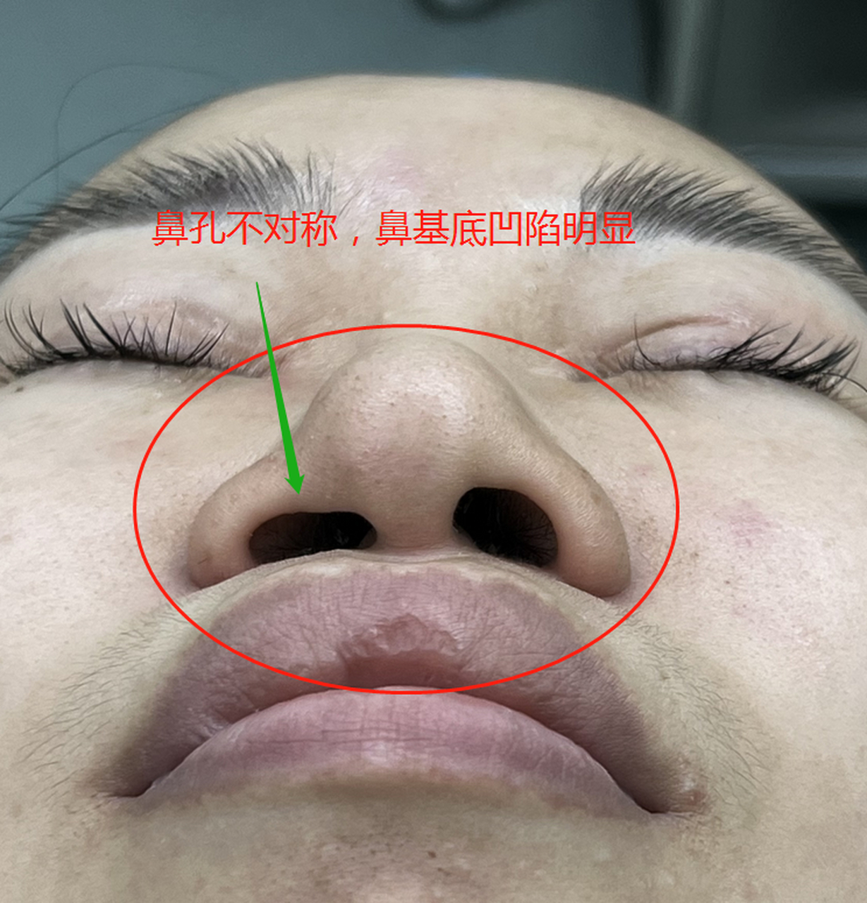 25岁的小姑娘鼻小柱发育短小,鼻基底凹陷,加上双侧鼻孔不对称,ct片子