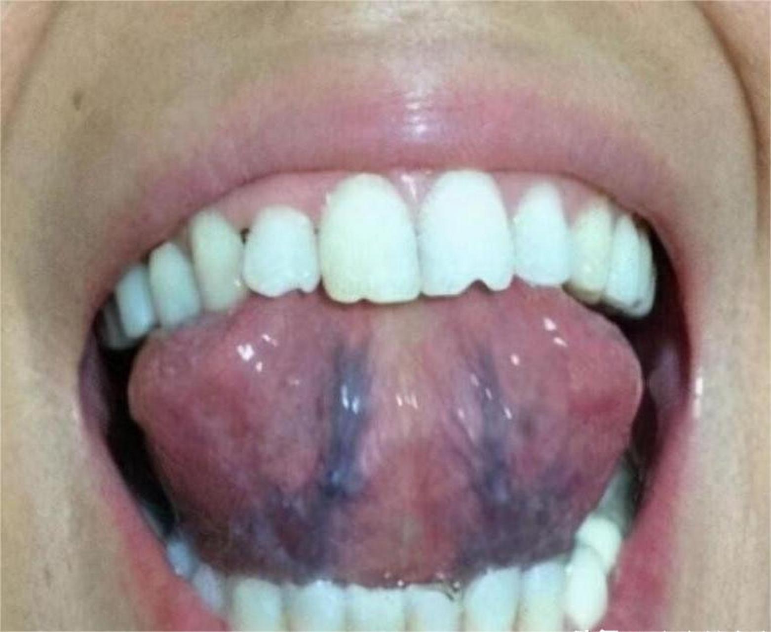 舌头下面的颜色图片