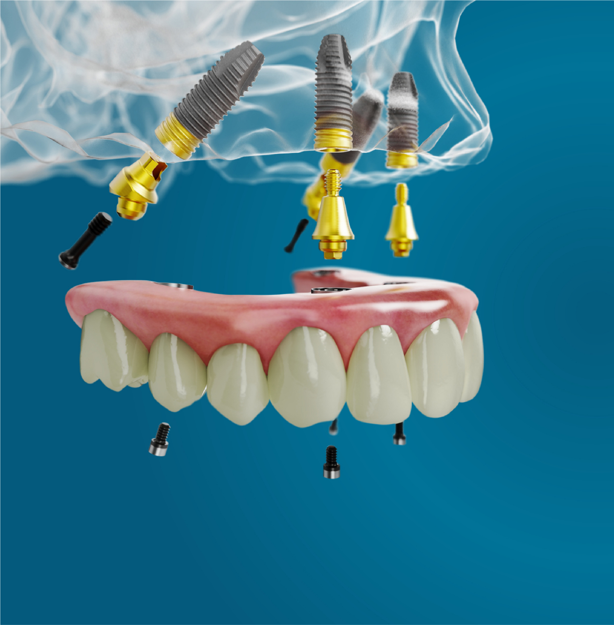 种植牙高端品牌怎么选,牙姐推荐诺贝尔和士卓曼-iti: 1,诺贝尔:诺保科