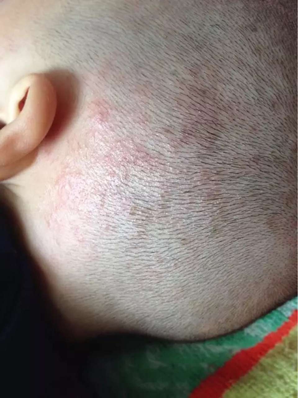 头上起小疙瘩可能与上火有关,也可能是其他皮肤问题引起的.