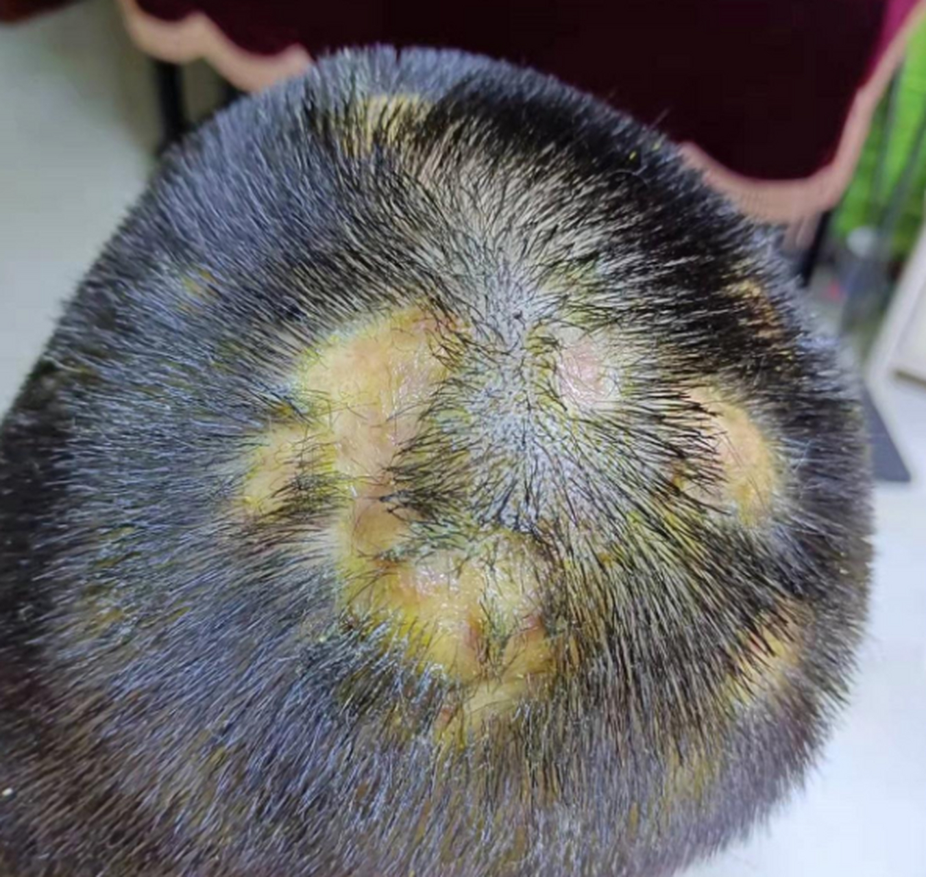 非常病例# 小伙子,28岁,患穿掘性毛囊炎3年了,头上一直反反复复地