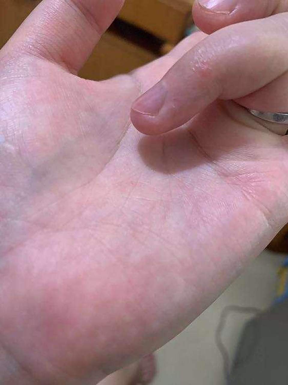 手上起小水泡(有照片,很痒,是汗疱疹吗?