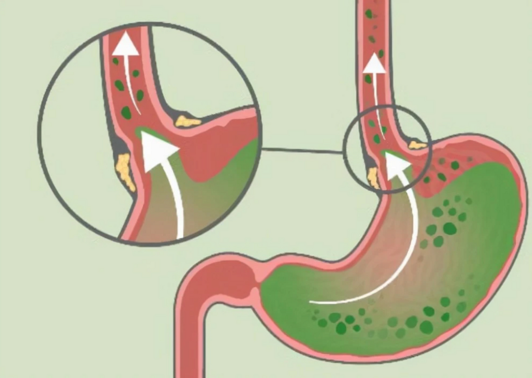 小心这可能是肝胃不和引起的胃食管反流 你是否经常感到胃酸倒流,出现