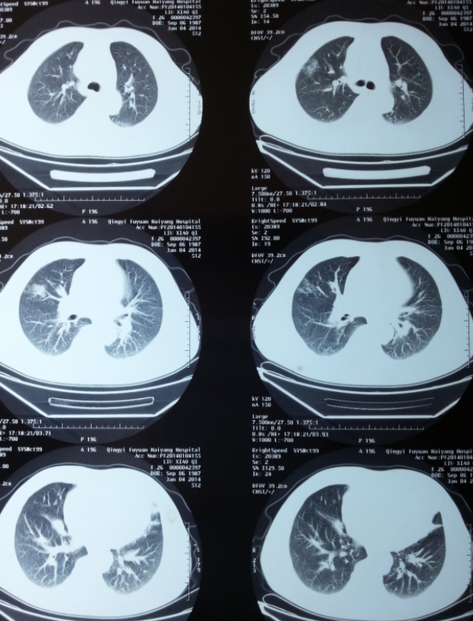 对于小于 5mm 的肺部磨玻璃结节,推荐在1年后进行胸部ct复查.