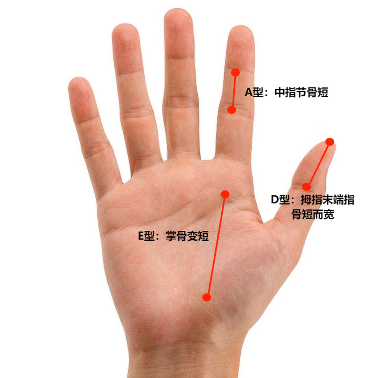 今天这个小朋友,双手集齐了3种短指症,a型,d型,e型短指  a型短指:就是