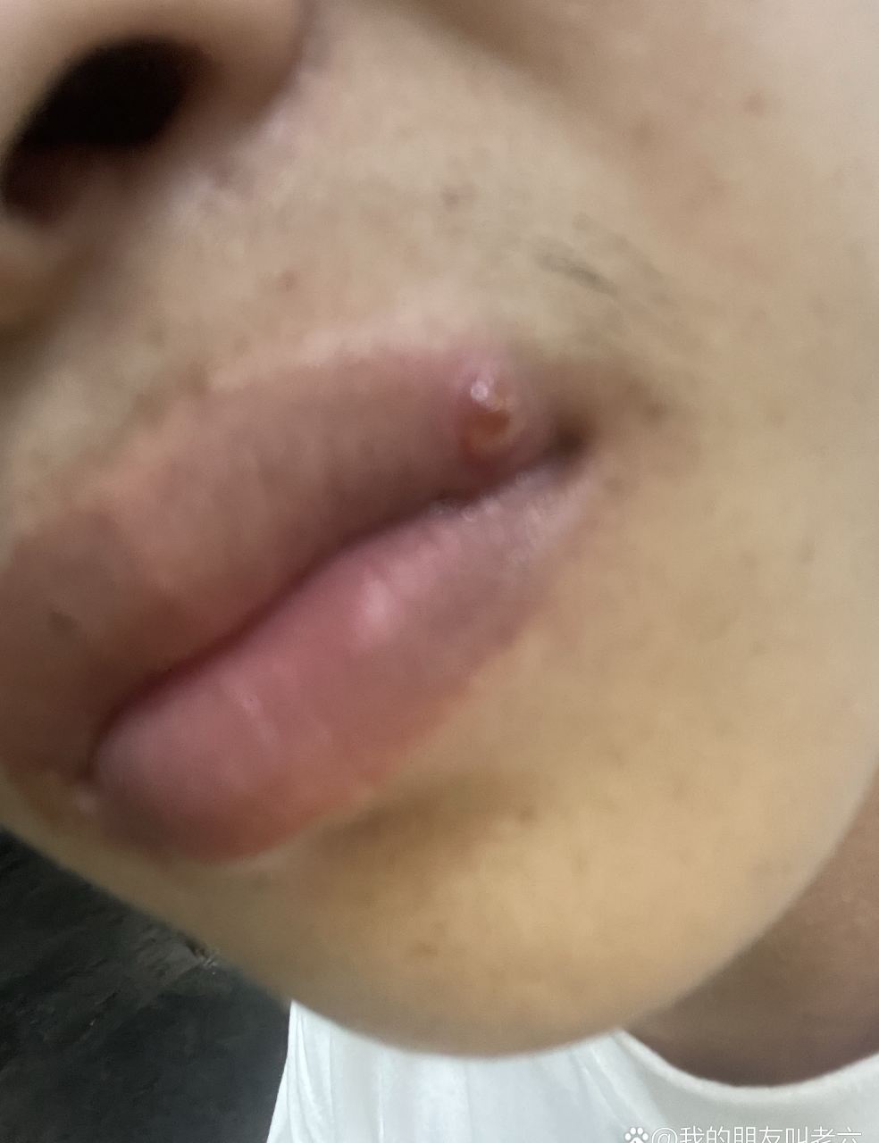 嘴巴怎么了,长了个大疙瘩[泪浪][你懂的]