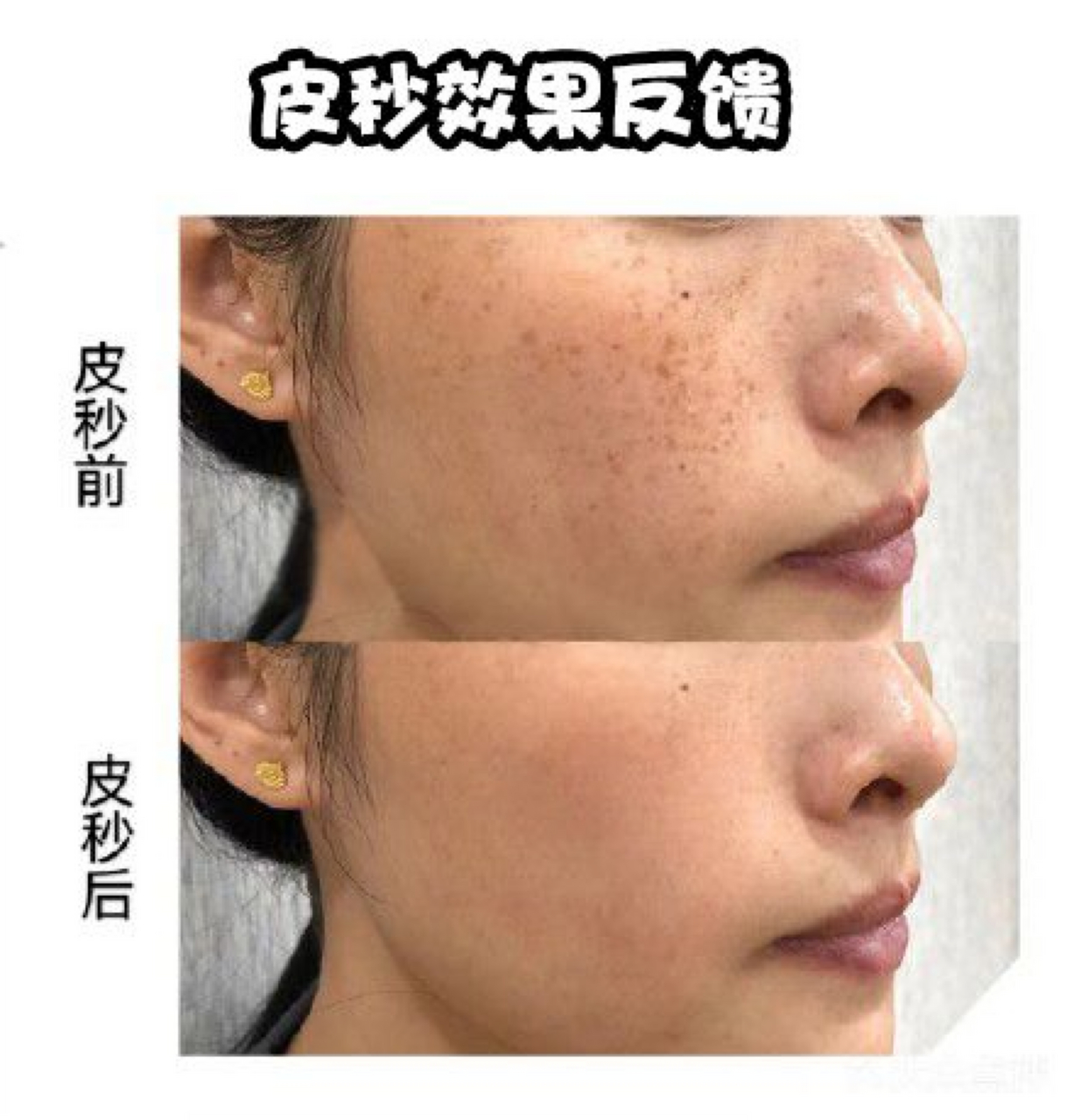 皮秒去黑色素几天有效果?