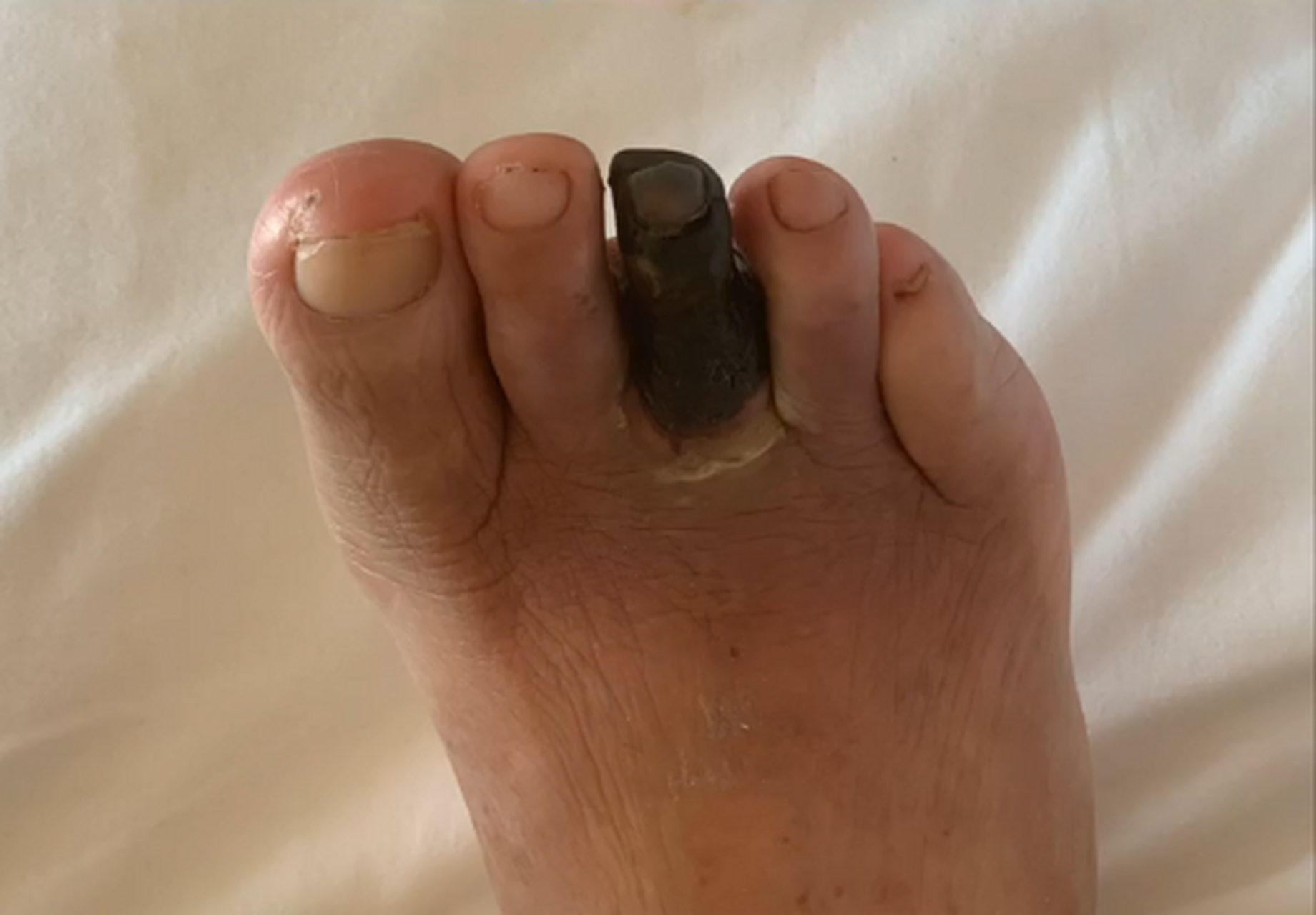 这位患者63岁,糖尿病20多年,但从不在乎.