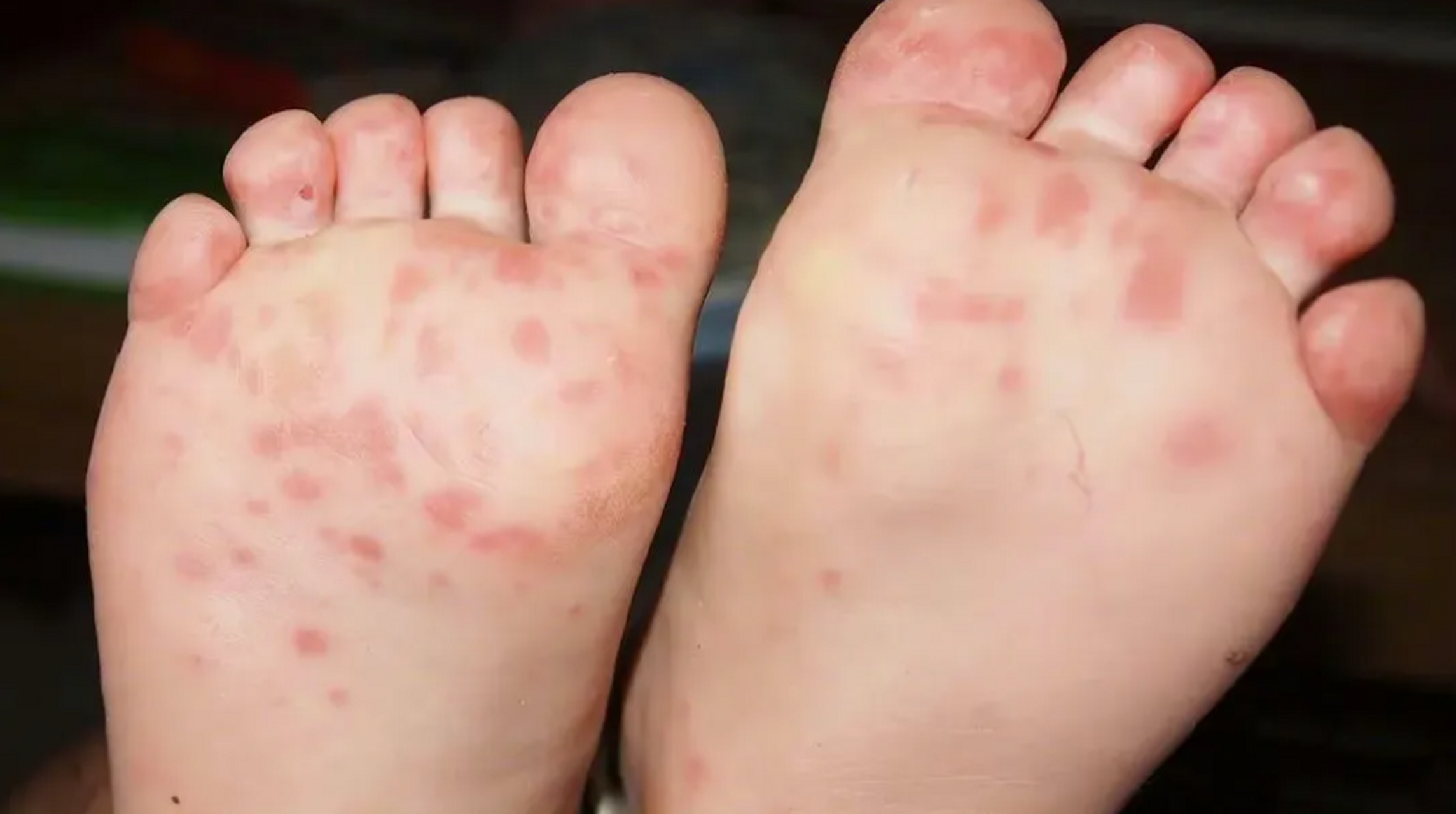 手足口病已进入高发期  手足口病是由肠道病毒引起的急性发热出疹性