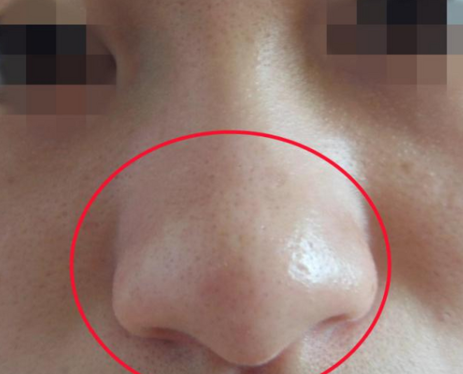 不会的,大鼻头只跟遗传和发育有关,不会因为你的天天挤压而变大,如果