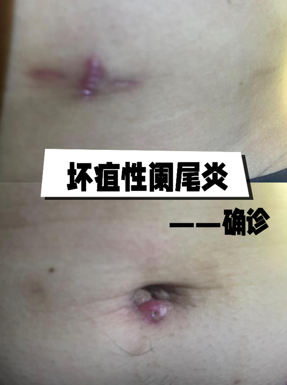 坏疽性阑尾炎——确诊#急性阑尾炎# #疾病治疗经验# #健康经验笔记
