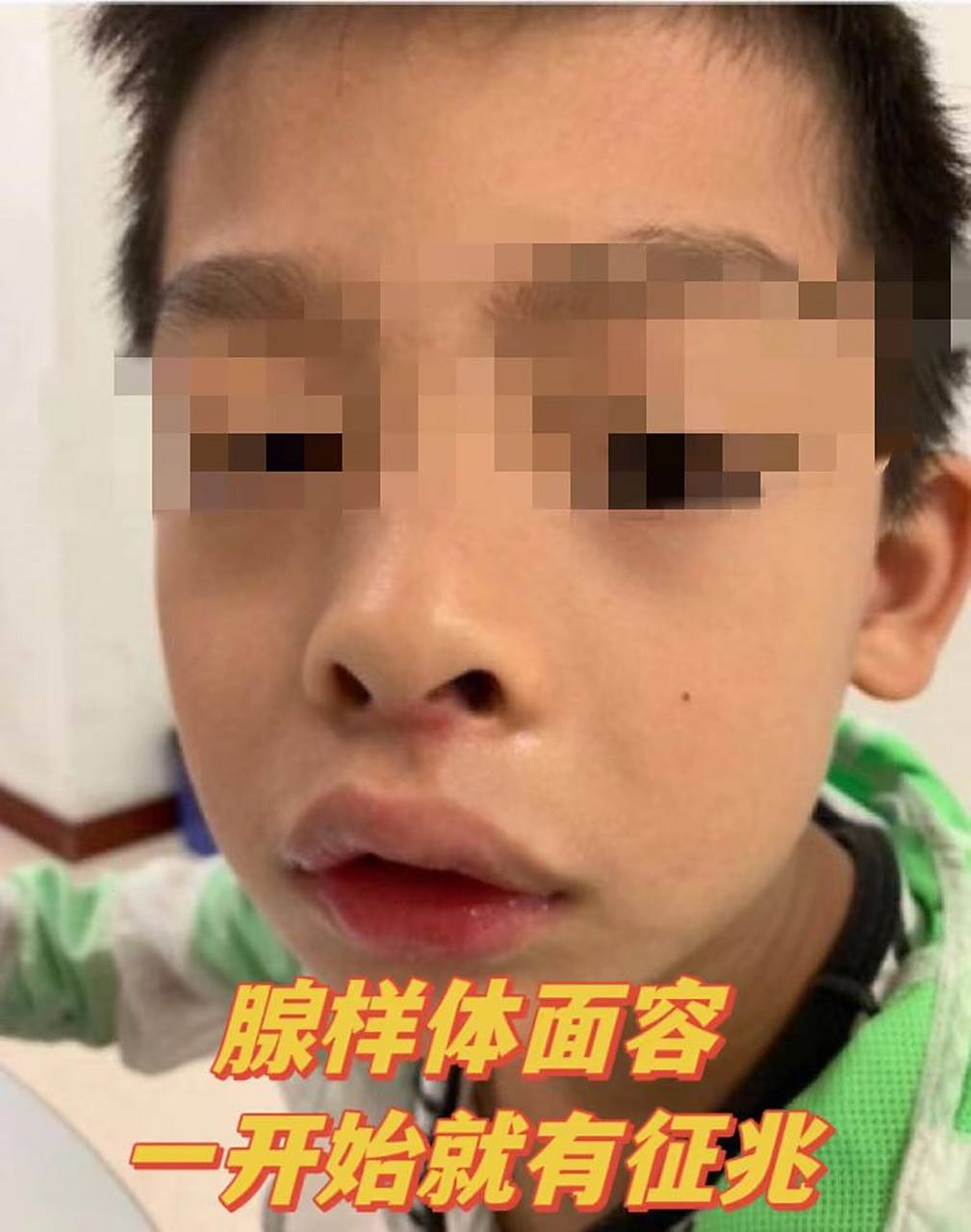 1,鼻塞 腺样体肥大会堵塞后鼻孔,导致孩子鼻子