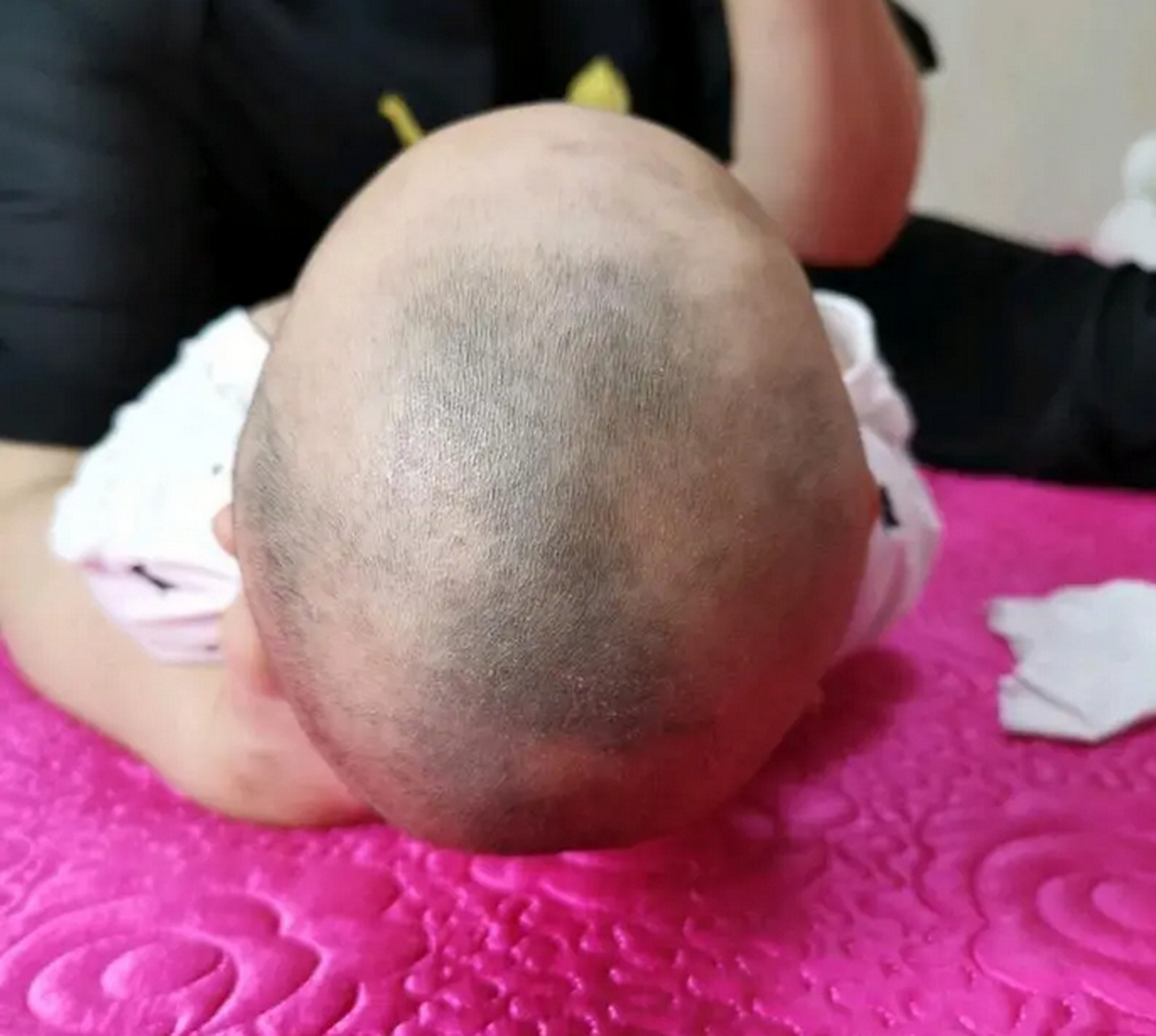 请问医生为满月的孩子需要纠正头型吗?怎么才能让孩子吧头睡圆?