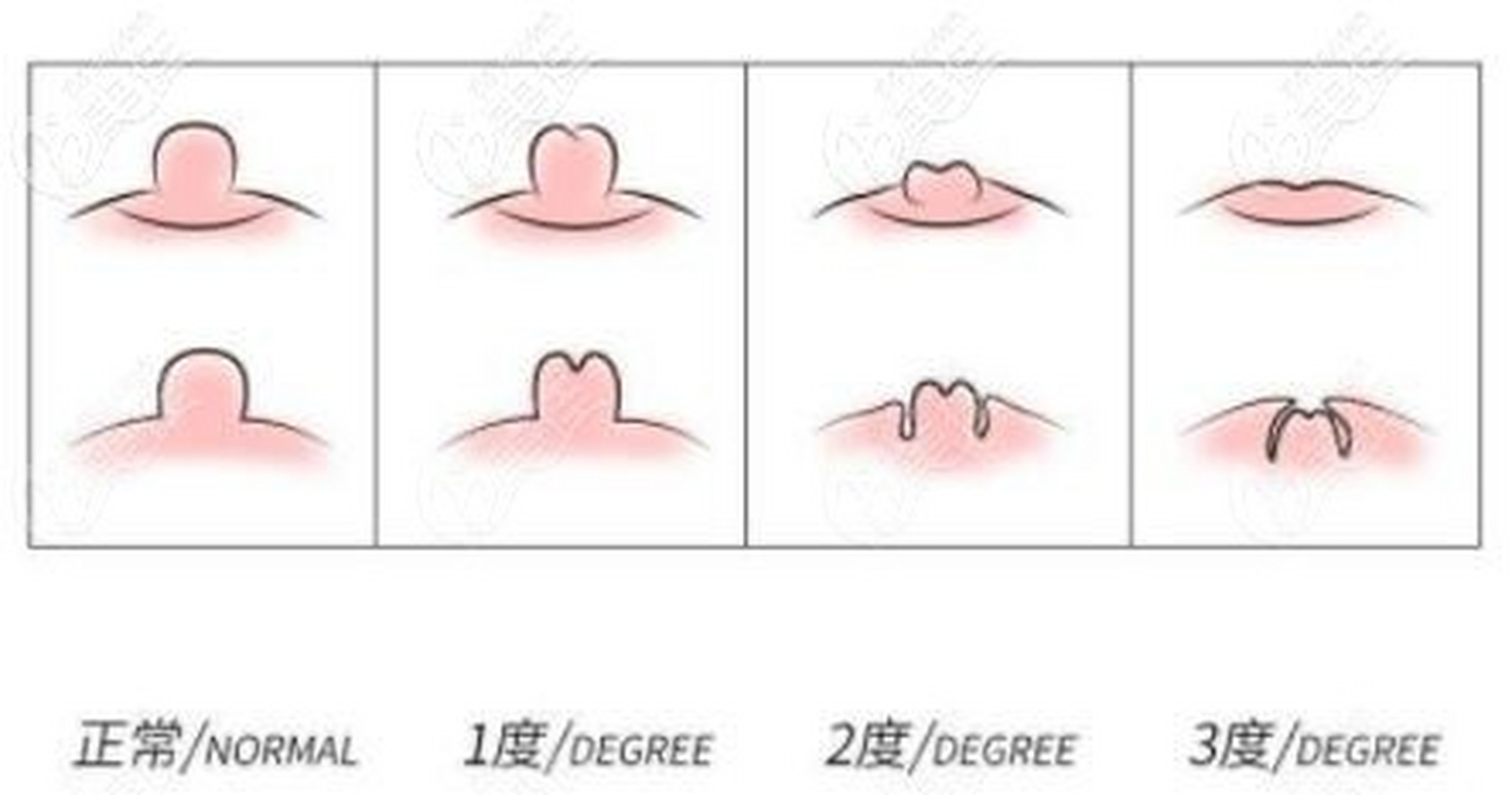 乳头内陷长见图片