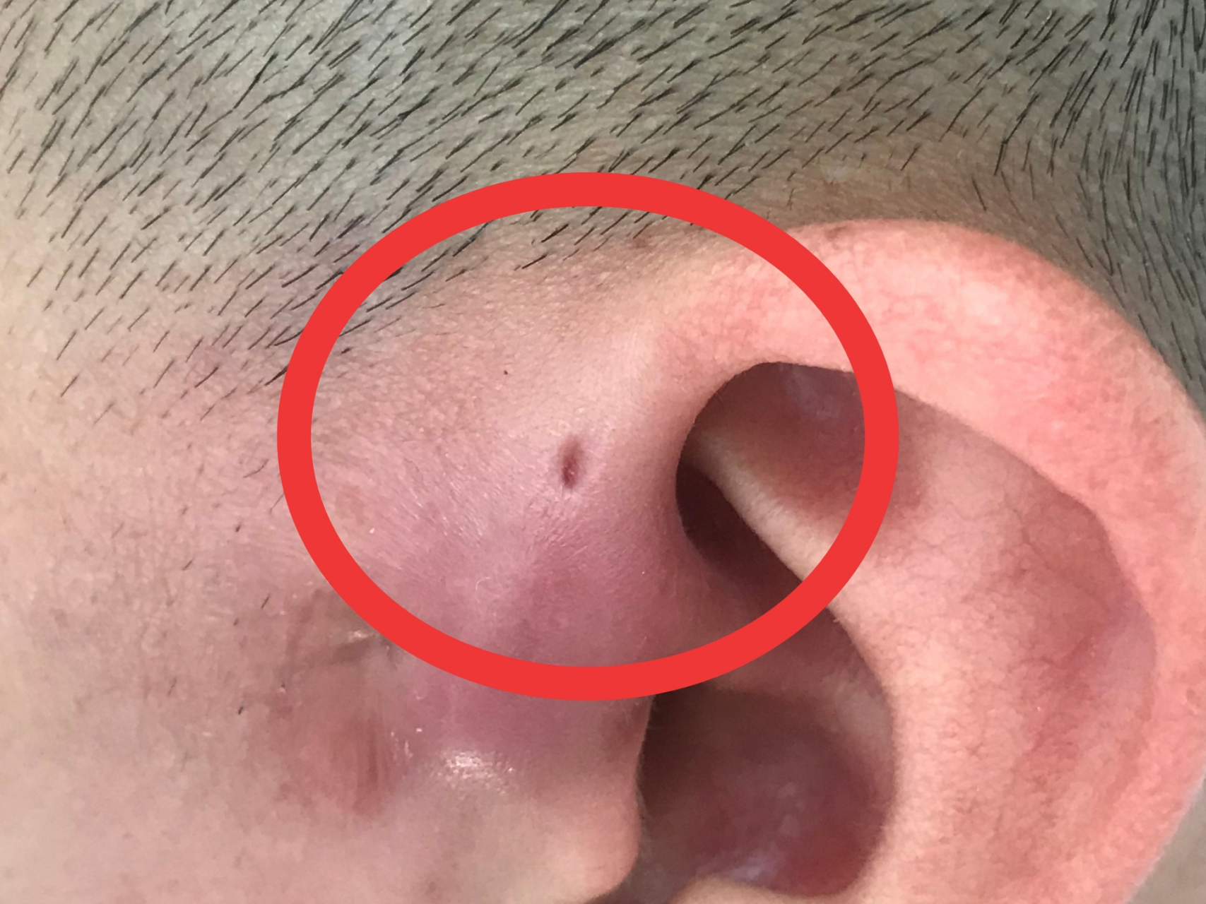 如果耳朵前发现这样的小孔,请立即到医院就诊!#耳前瘘管