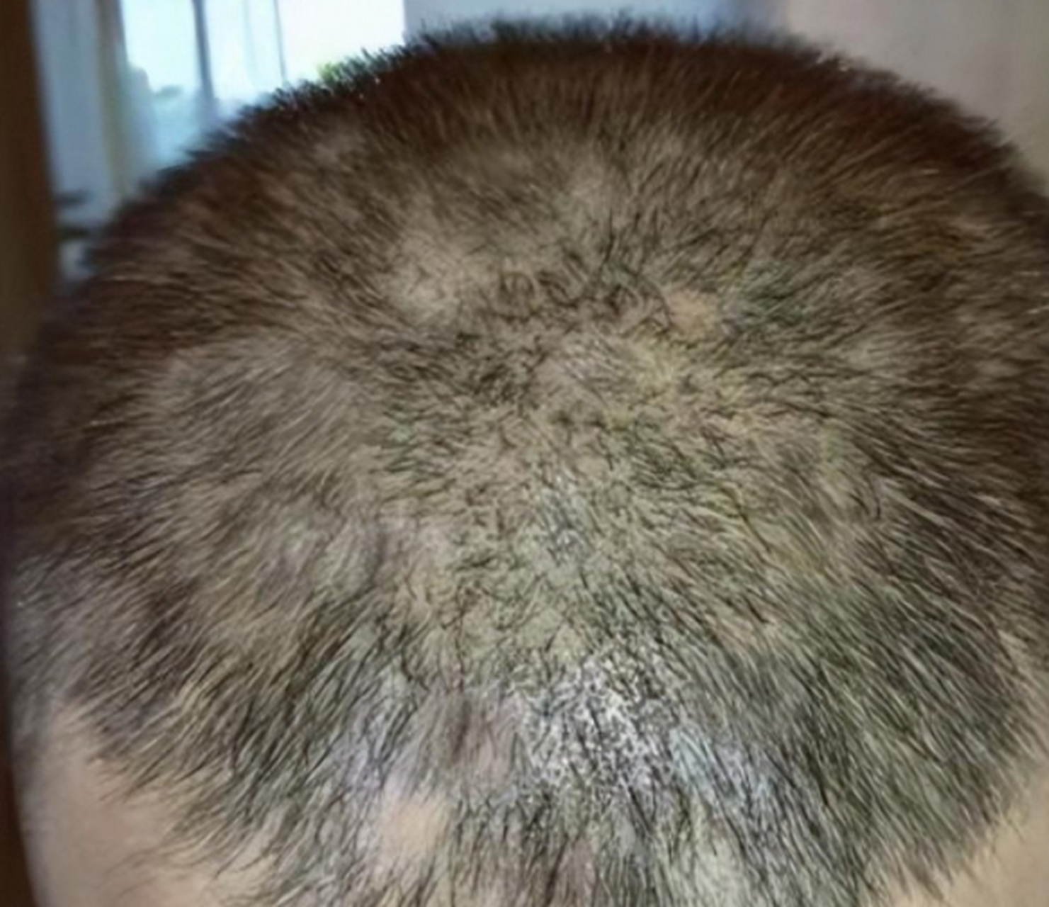 这位患者,毛囊炎伴脱皮,头上成这个样子了(见图1) 通过中医问诊发现