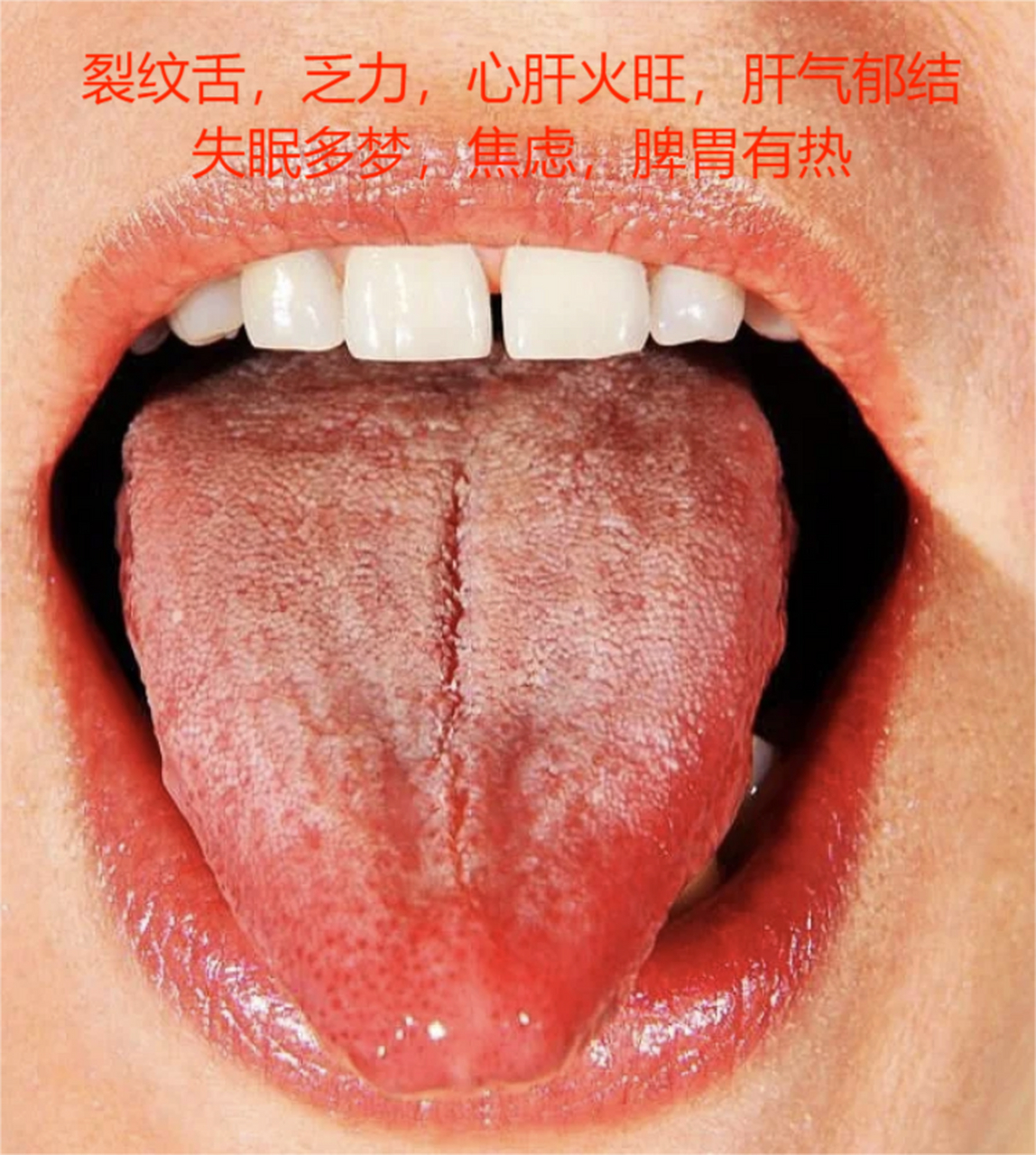 每日分享舌象分析图,大家可以看看自己的舌头,对比一下!