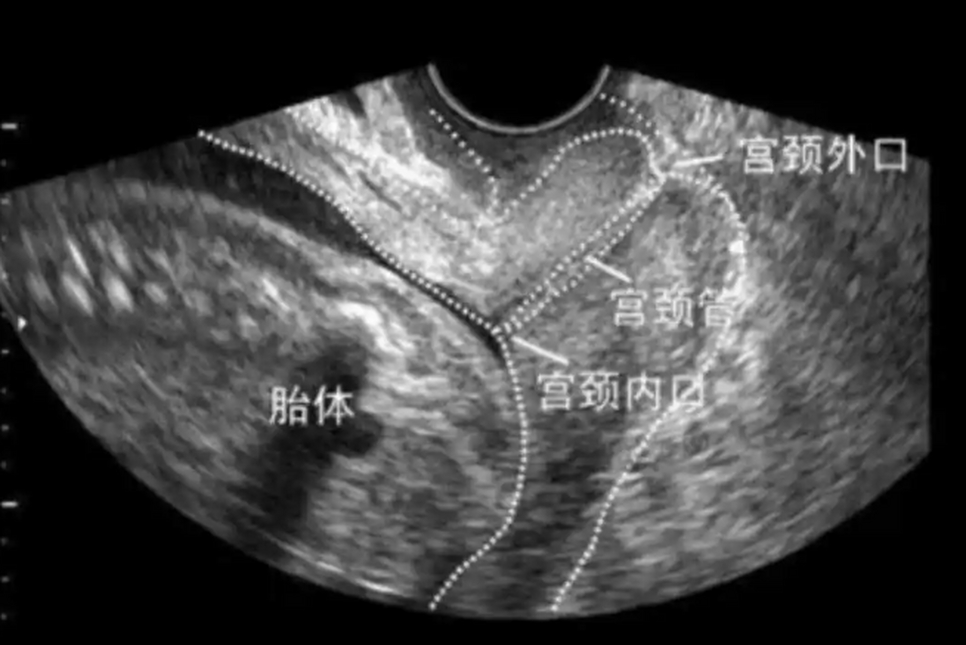 顺产后宫颈图片形状图片