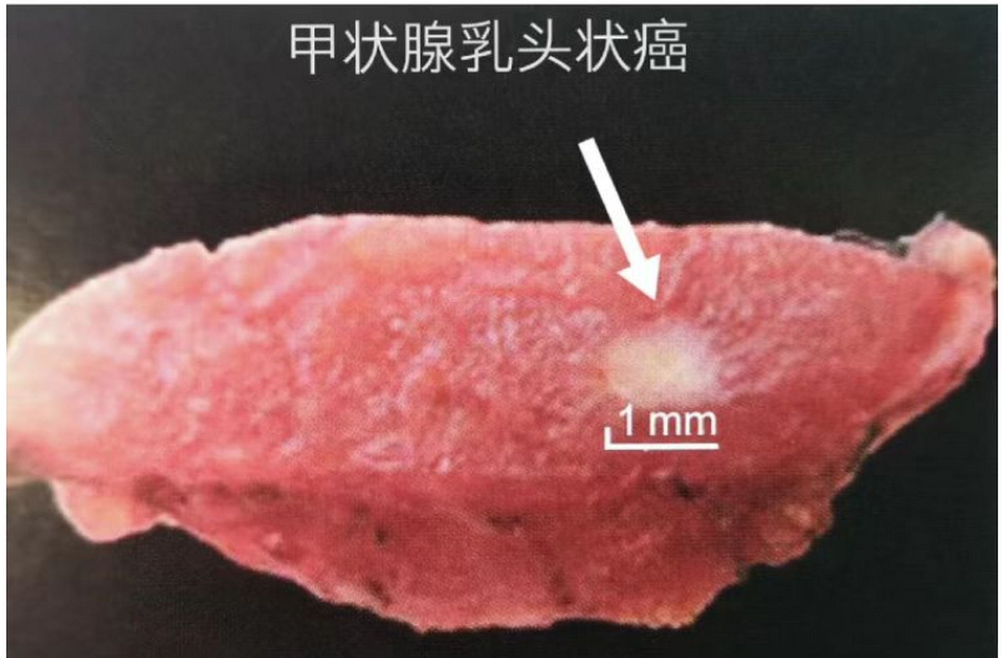 乳头状癌图片