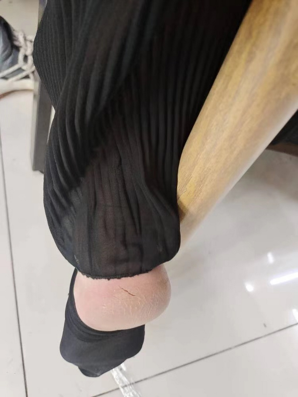 脚后跟干裂起硬皮,经常裂口子,这是脚气吗 【患者提问】女,36岁,脚