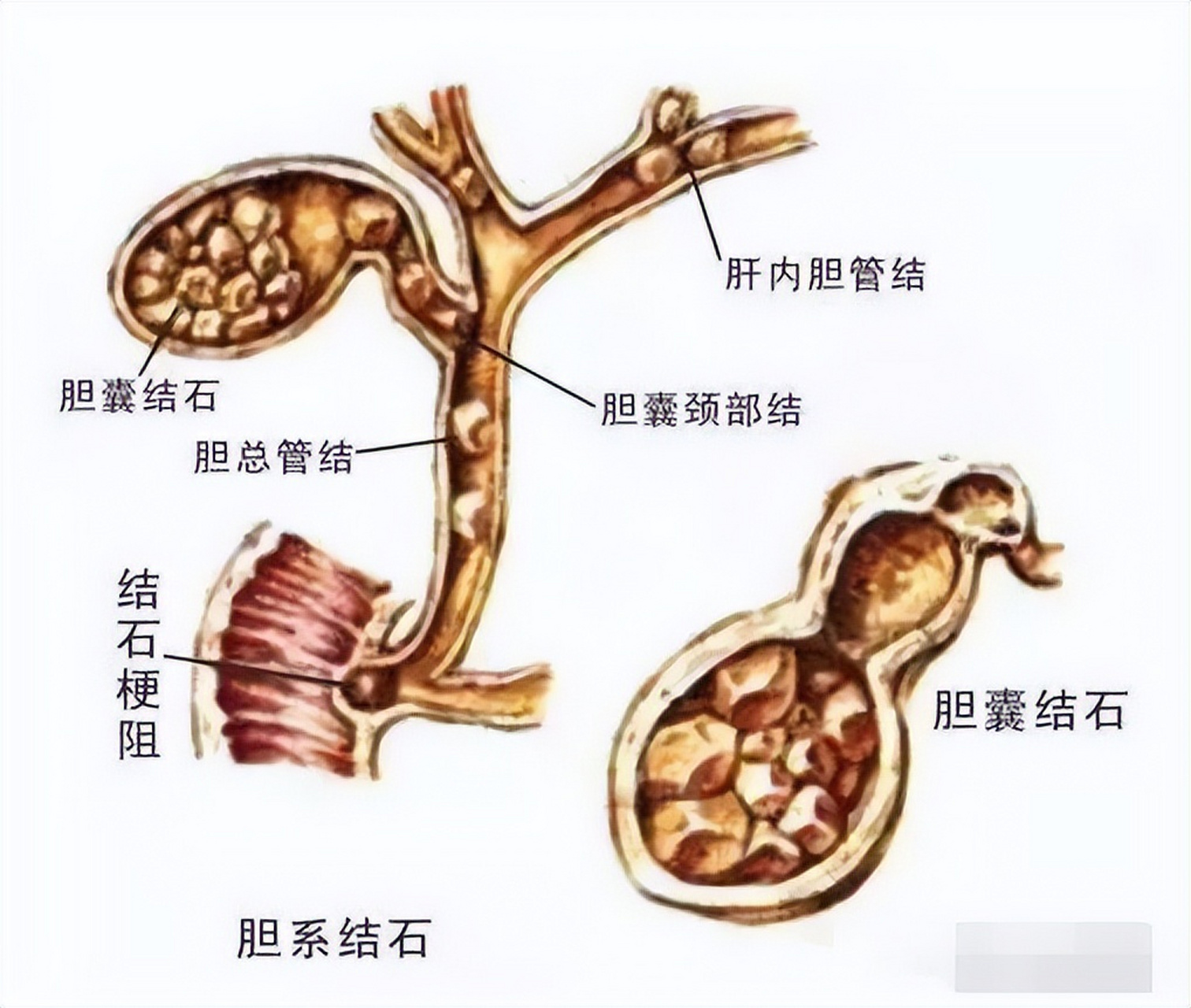 得了胆结石,还能不能好好吃鸡蛋?