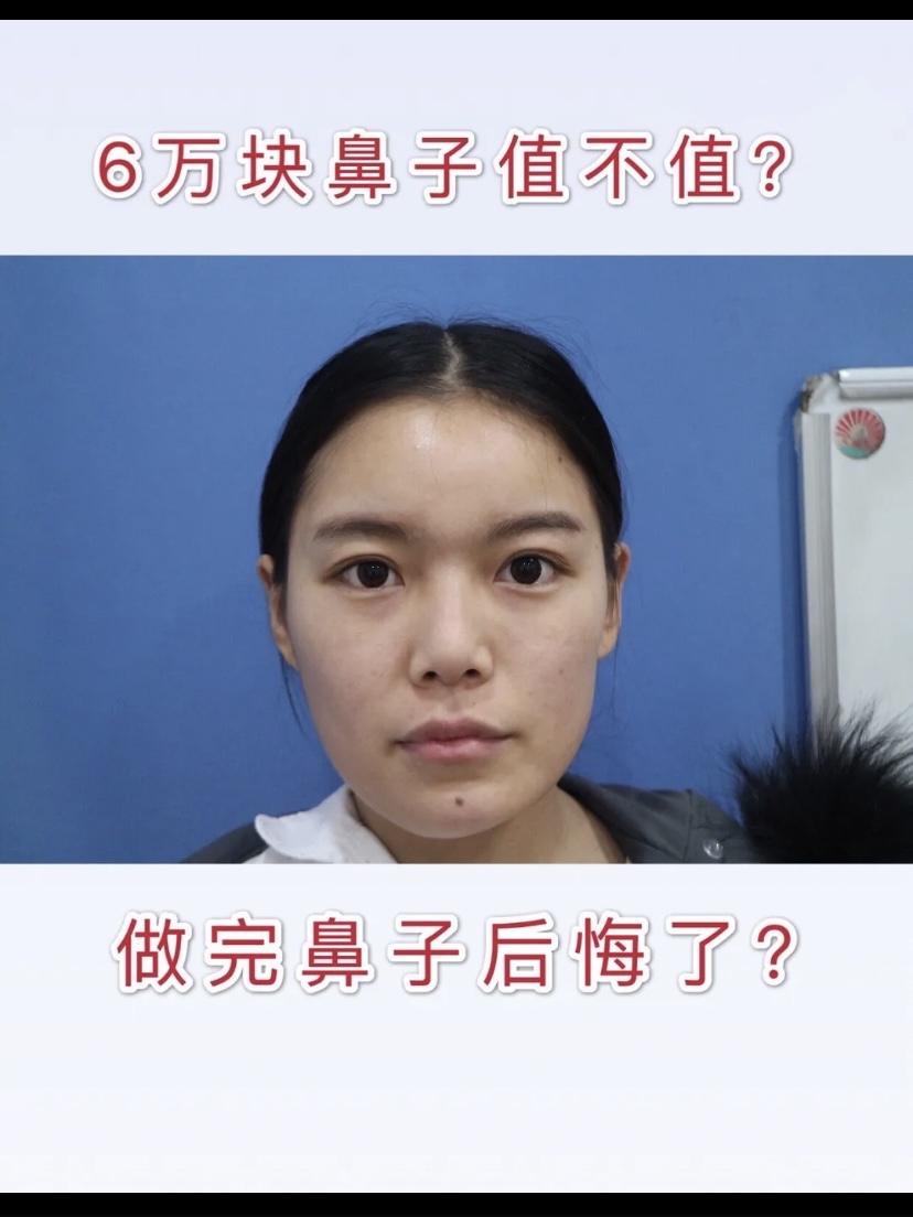 做鼻子要花多少钱?