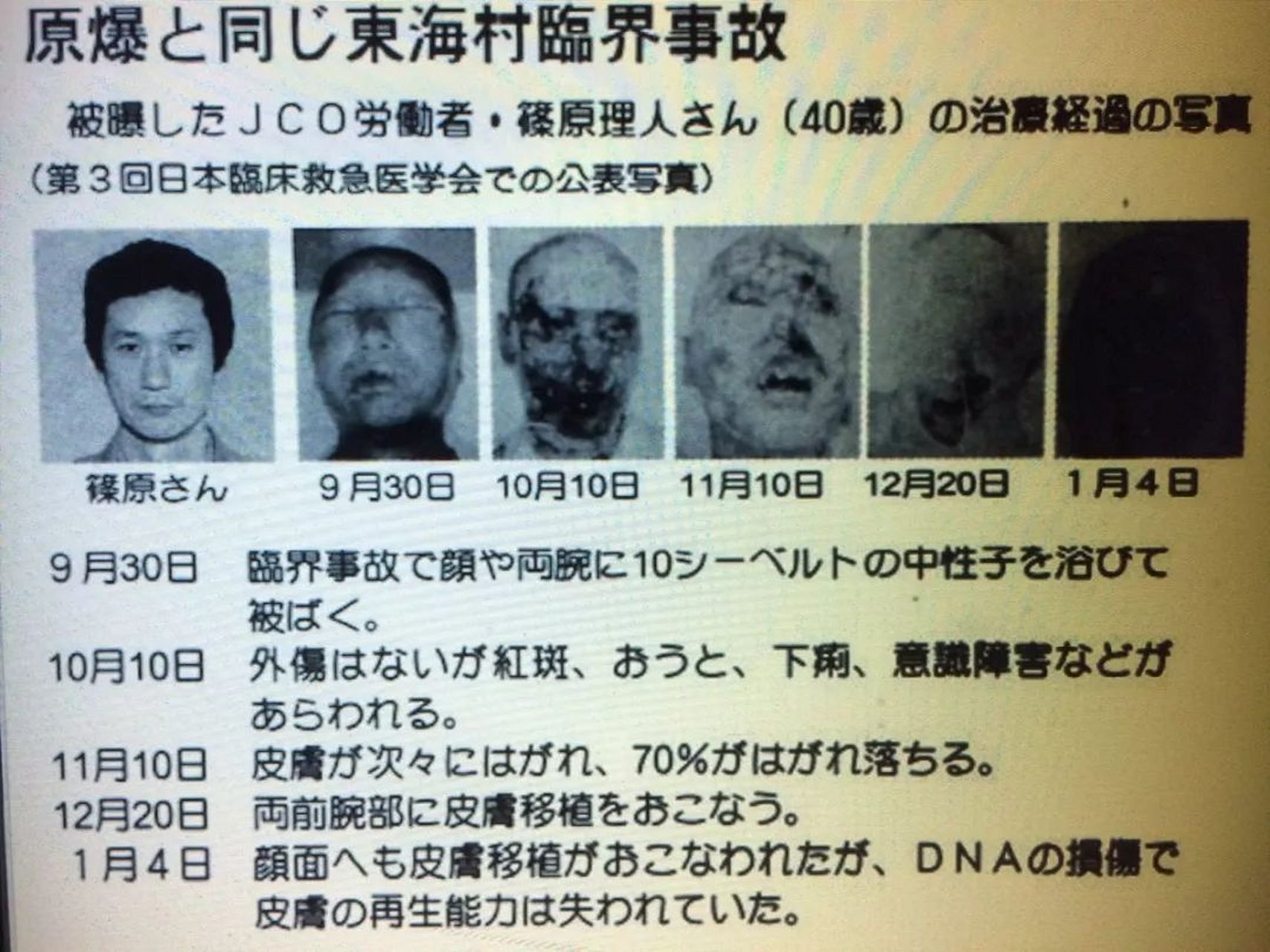 日本男人惨遭核辐射,全身融化生不如死