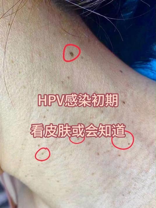 hpv阳性有什么症状图片图片