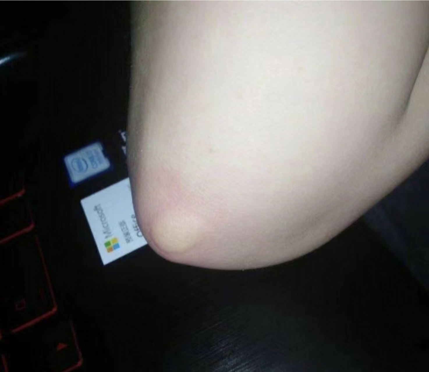 被蚊子咬了,肿了一个大包,感觉是招蚊子体质,这个夏天要怎么办?