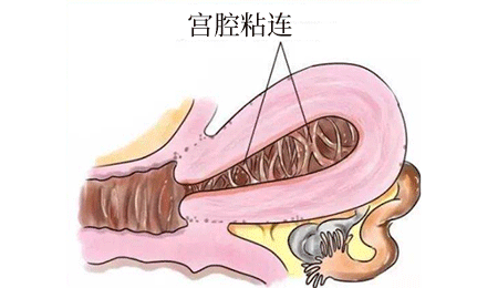 怀疑自己存在宫腔粘连,这几步轻松教你判断