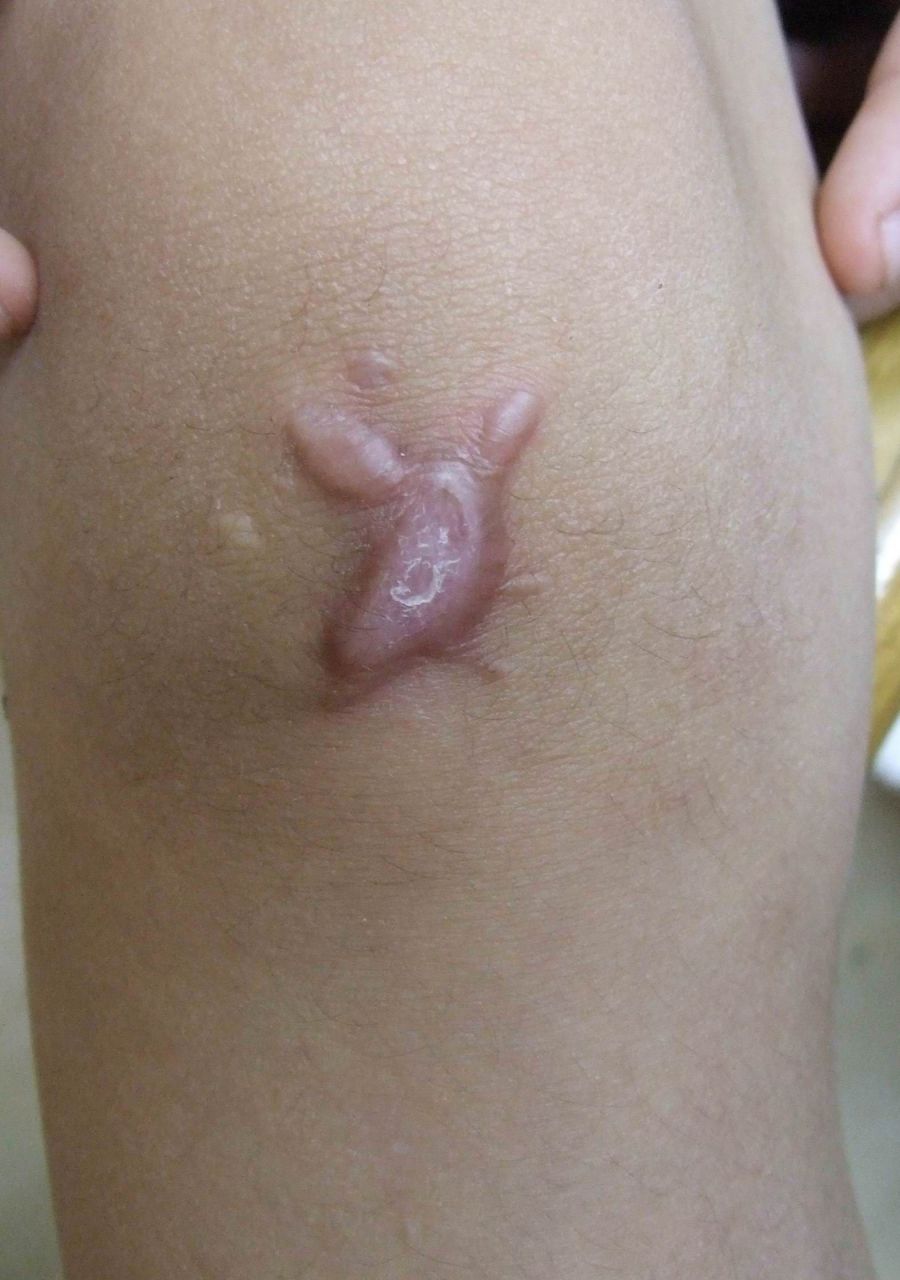 这种问题通常发生在手术,创伤或其他皮肤损伤后.