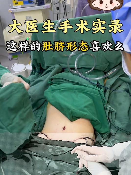 腹壁术后即刻实拍,看看什么是漂亮的肚脐