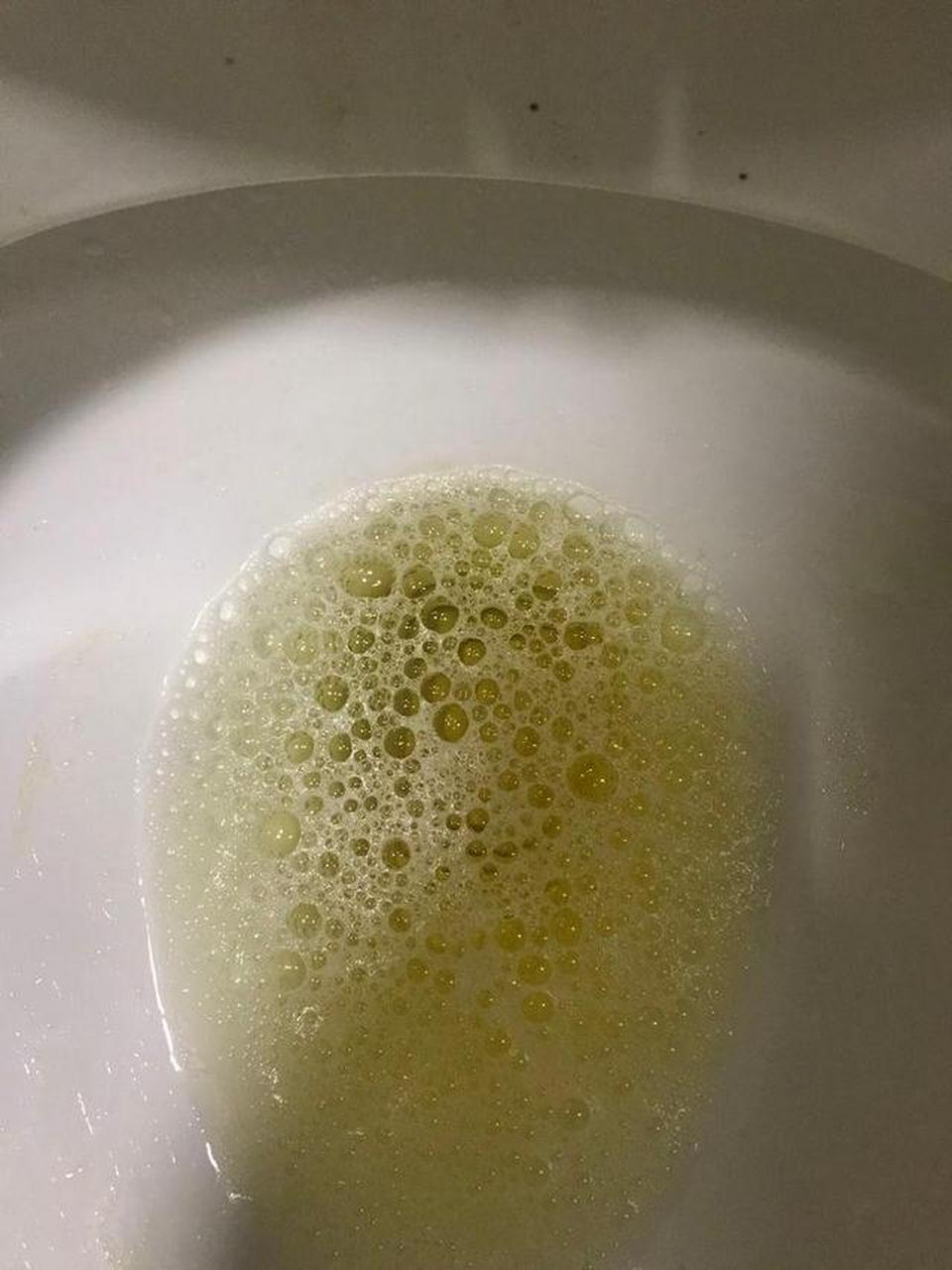 引起小便泡沫多的原因比较多,比如尿液浓缩,炎症,肾脏有问题.