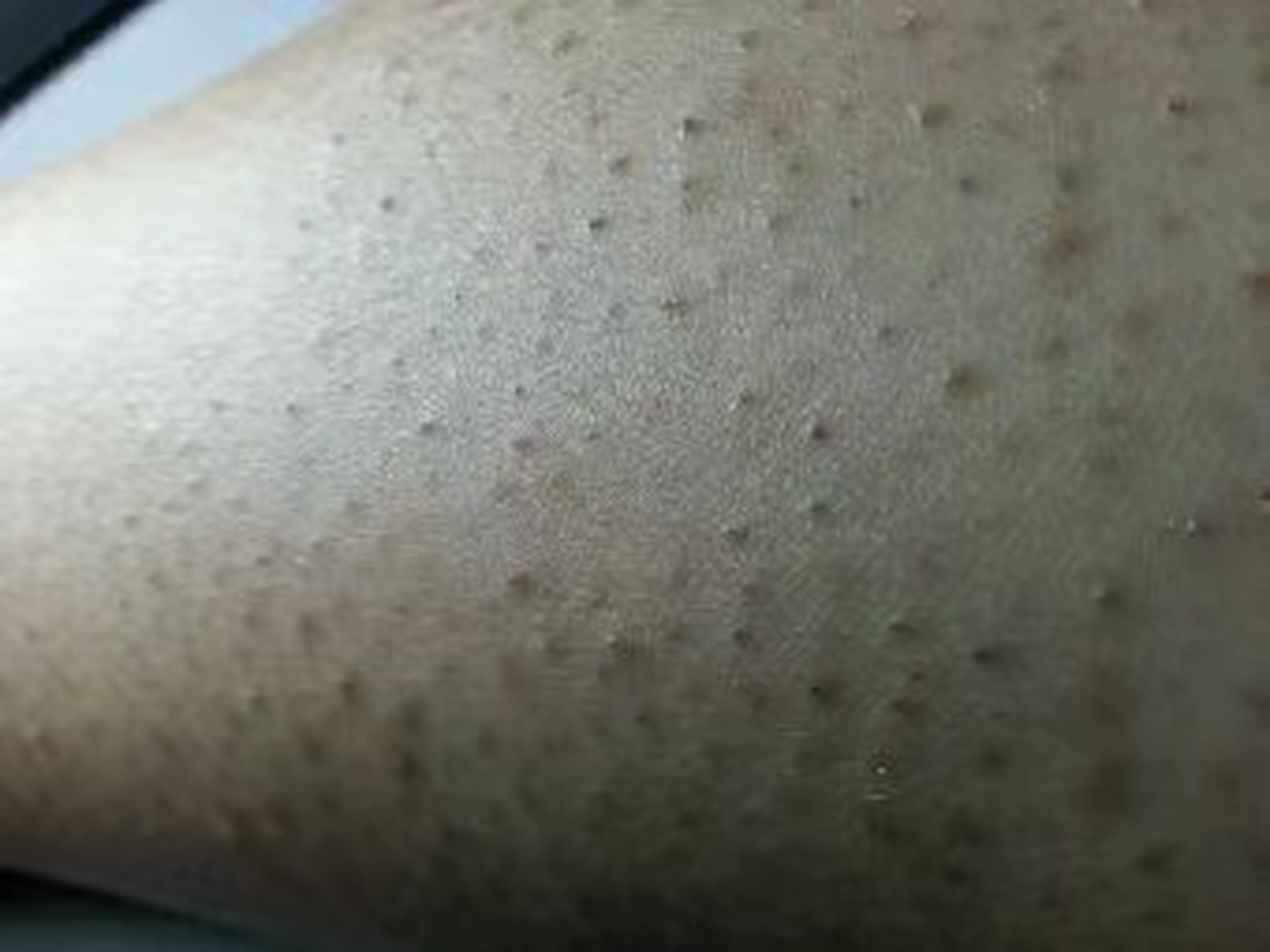 感染:  (1)细菌感染:大多数毛囊炎都是由细菌感染引起的,如金黄色葡萄