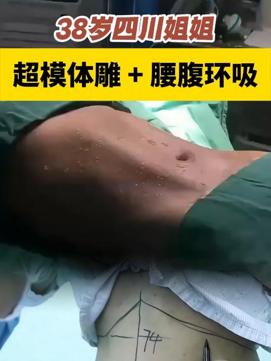 腰腹环吸 马甲线 吸脂 小蛮腰 重庆黄彪