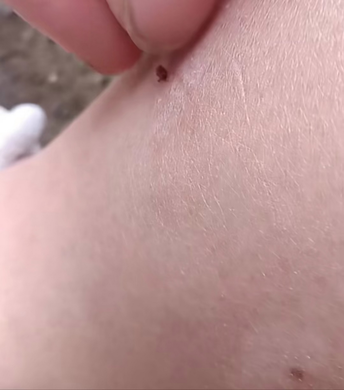 长这么大第一次被这样的虫子咬,而且还钻到肉里去了,挺疼的,这是什么
