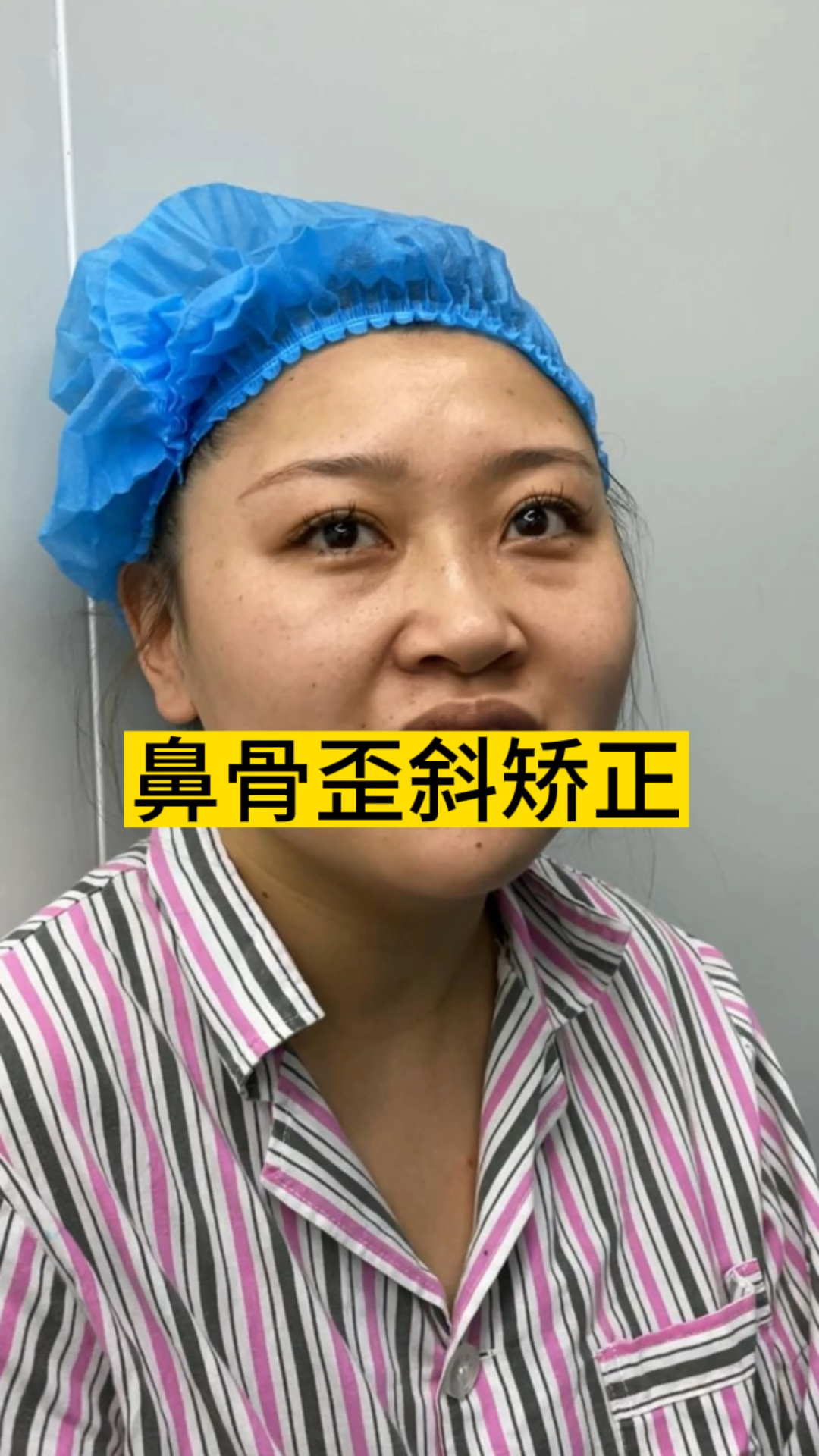 天生鼻骨歪斜,看看纠正后是什么样的-度小视