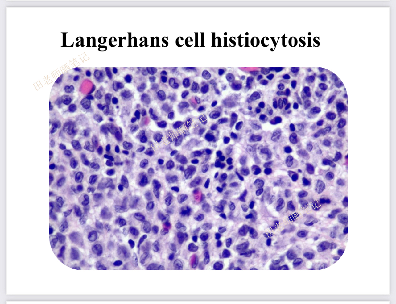 朗格汉斯细胞组织细胞增生症