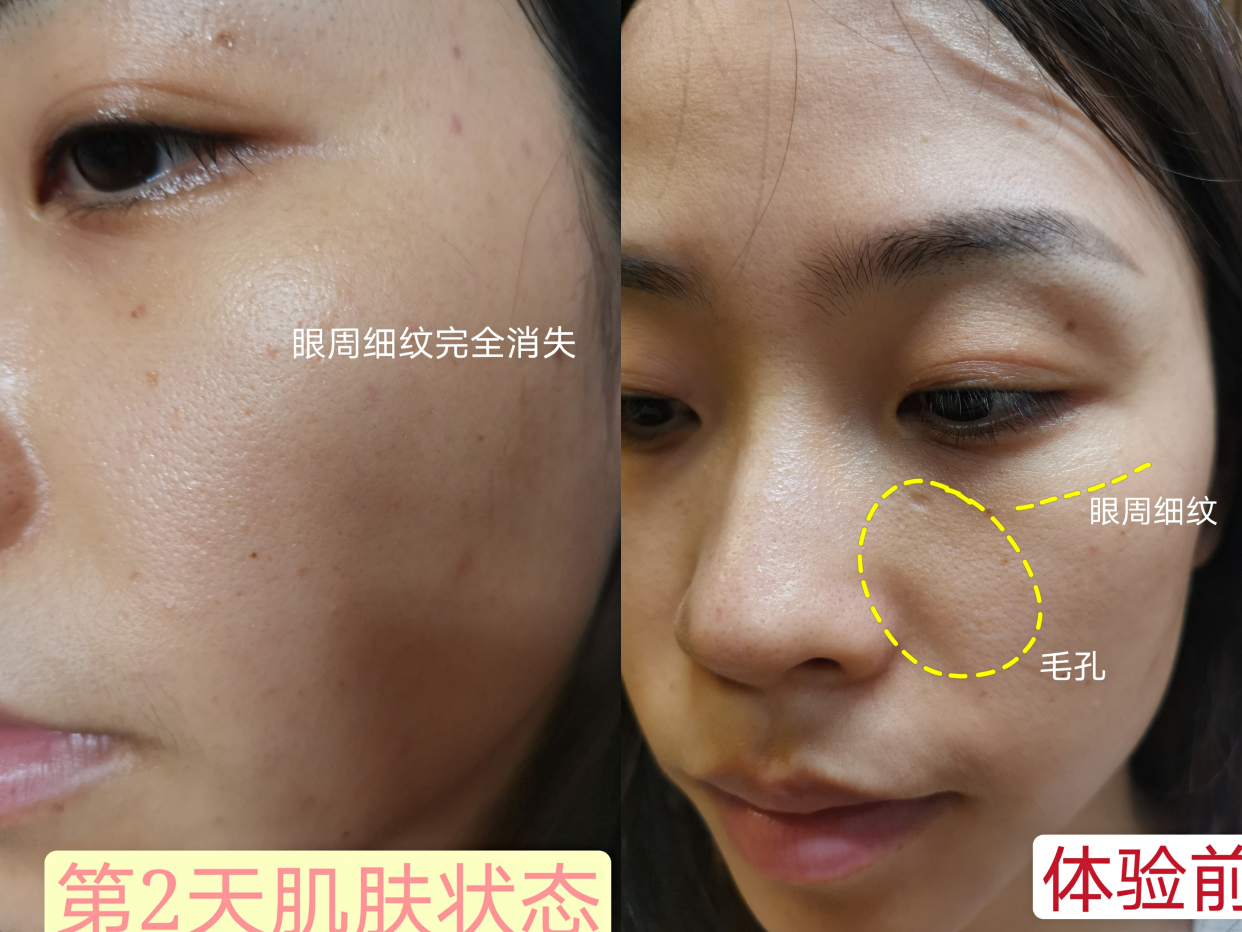 动能素 婴儿针,效果惊艳的一次水光针体验!