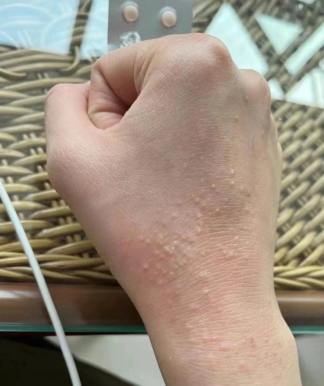 老年人皮肤瘙痒的原因及治疗…………  老年人皮肤瘙痒症发生部位多在