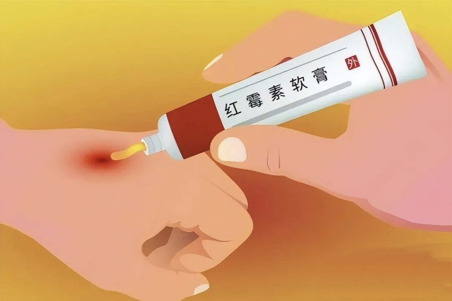 痤疮:红霉素软膏可以减轻痤疮引起的炎症和红肿,缩小毛孔,使皮肤更加