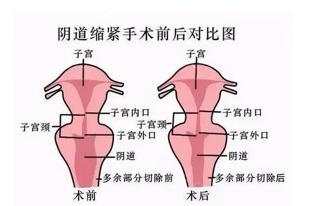 紧缩手术是怎么做的图片