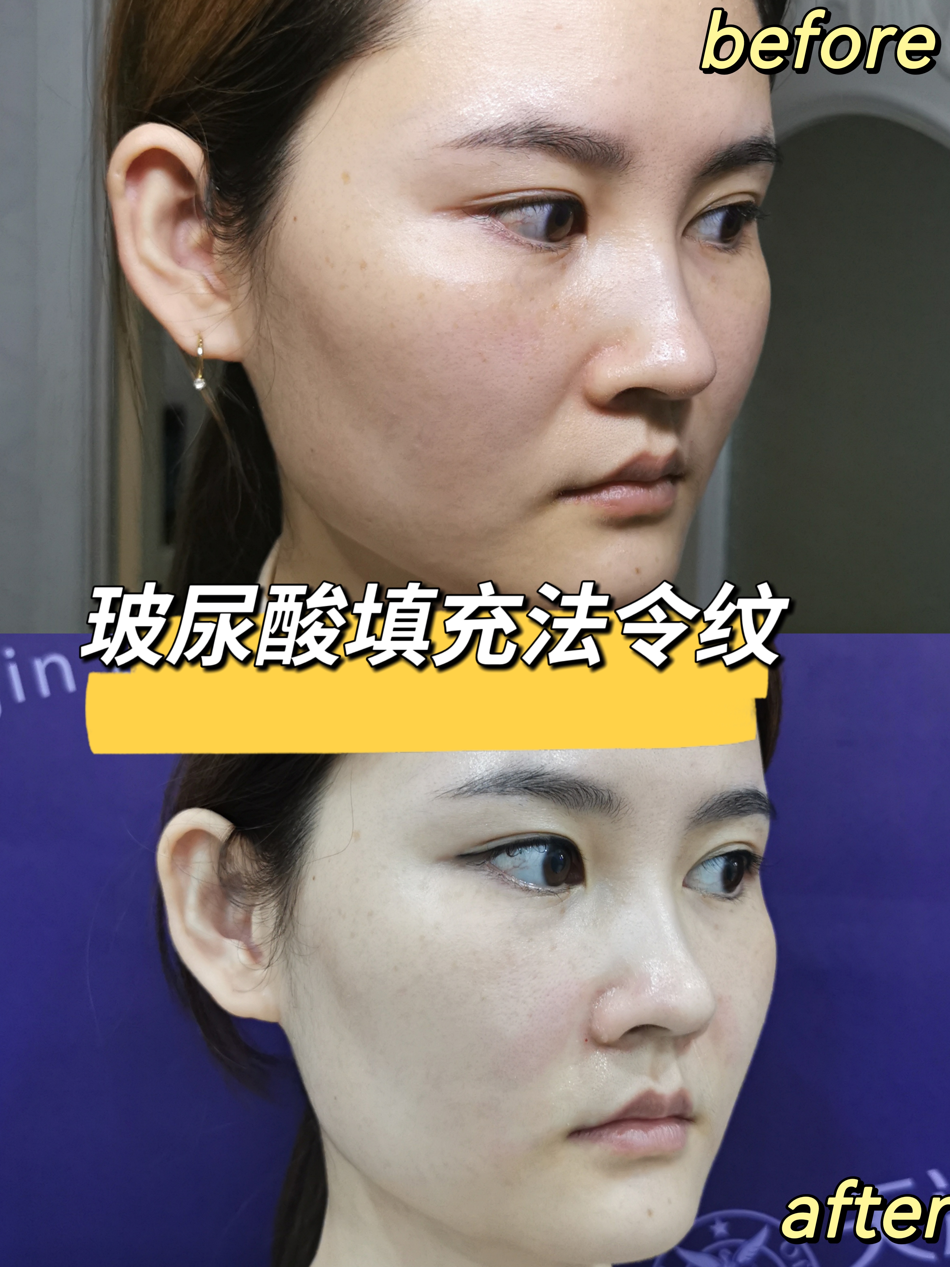 玻尿酸填充法令纹体验分享!