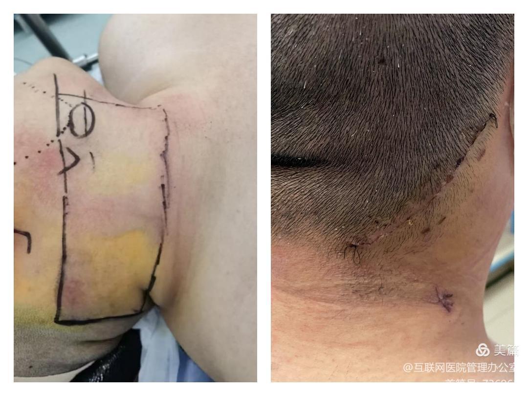 微创 美容～省内独家开展"腔镜颌下腺切除术"