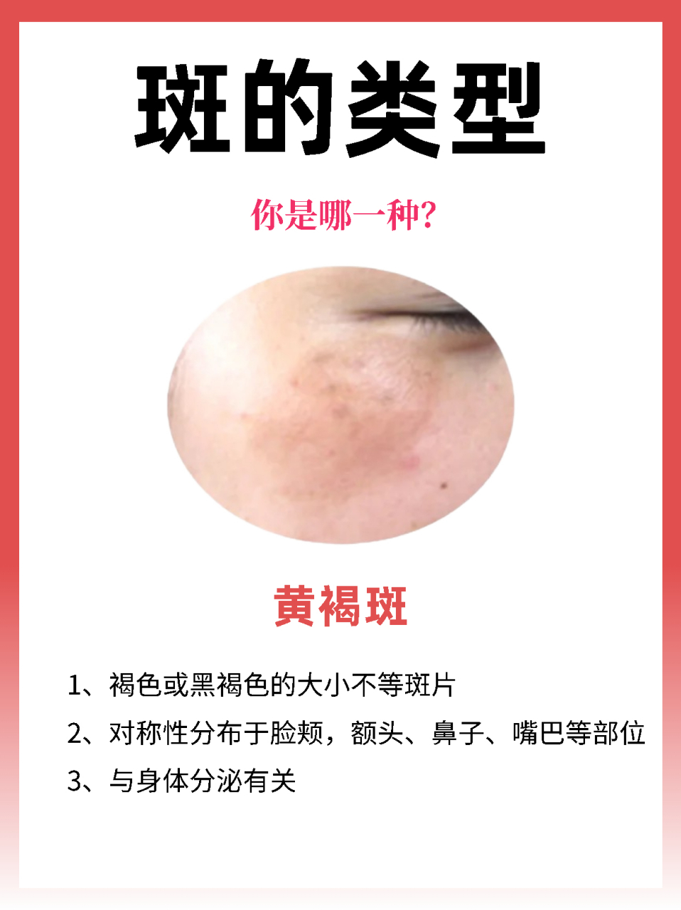 【斑的类型,你是哪一种?