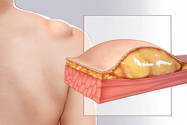 如何区分皮脂腺囊肿和脂肪瘤