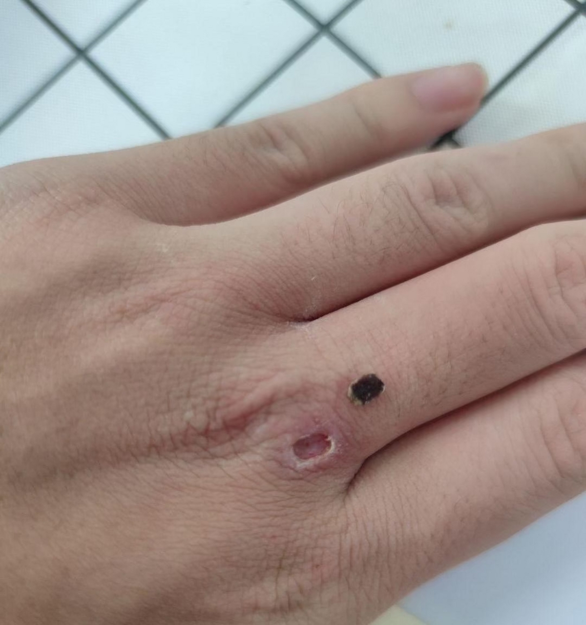 太开心了,三十几年的鸡眼终于掉了