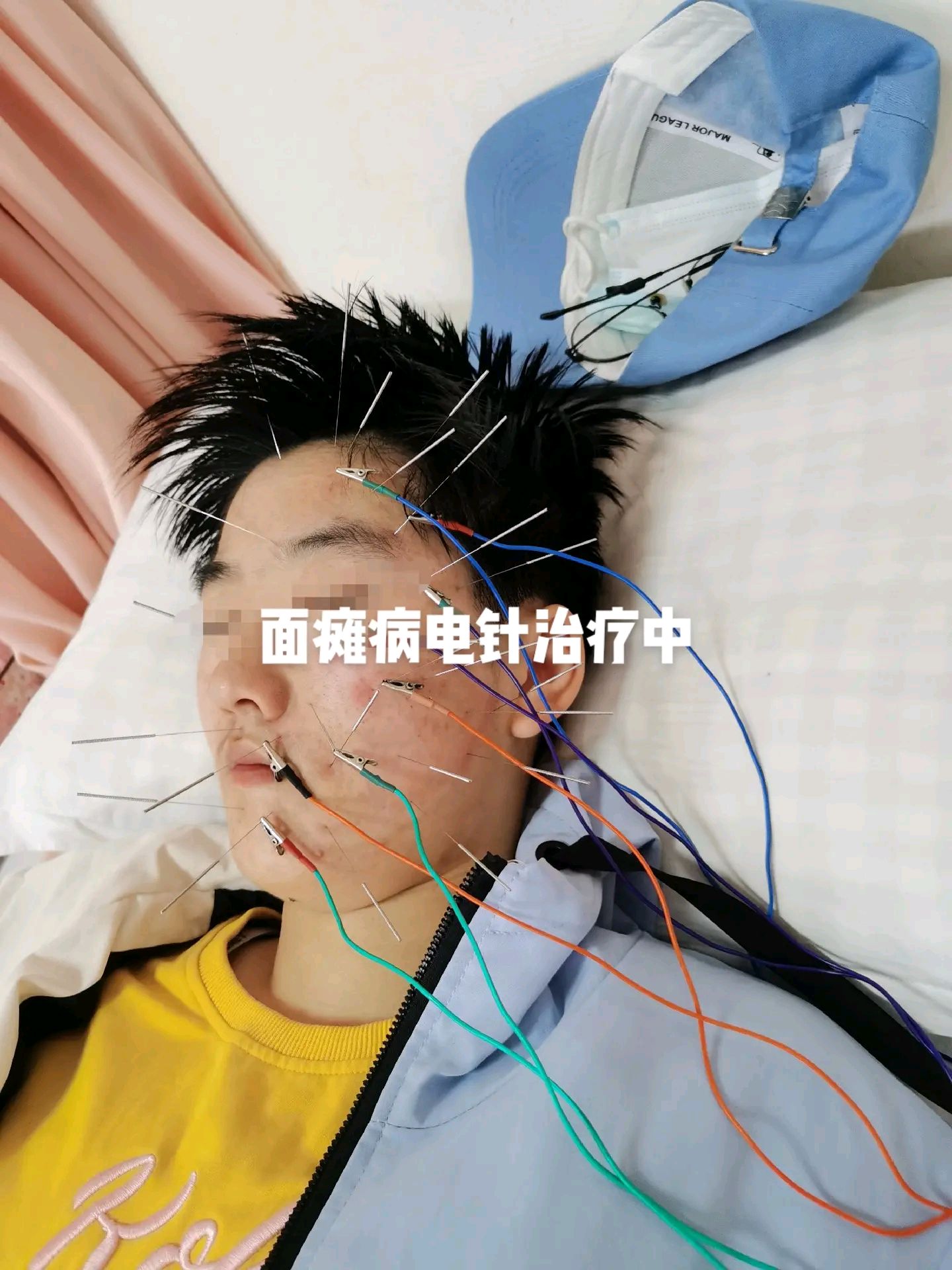 面瘫病电针治疗