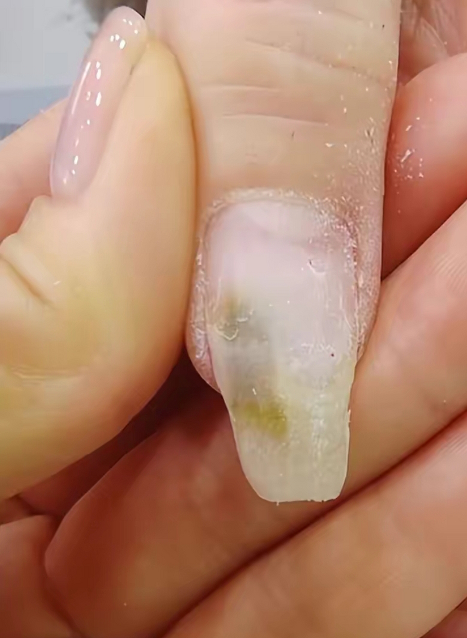 女子贴甲片后指甲发霉变绿,店老板:10个指头绿了6个,大拇指指甲和肉